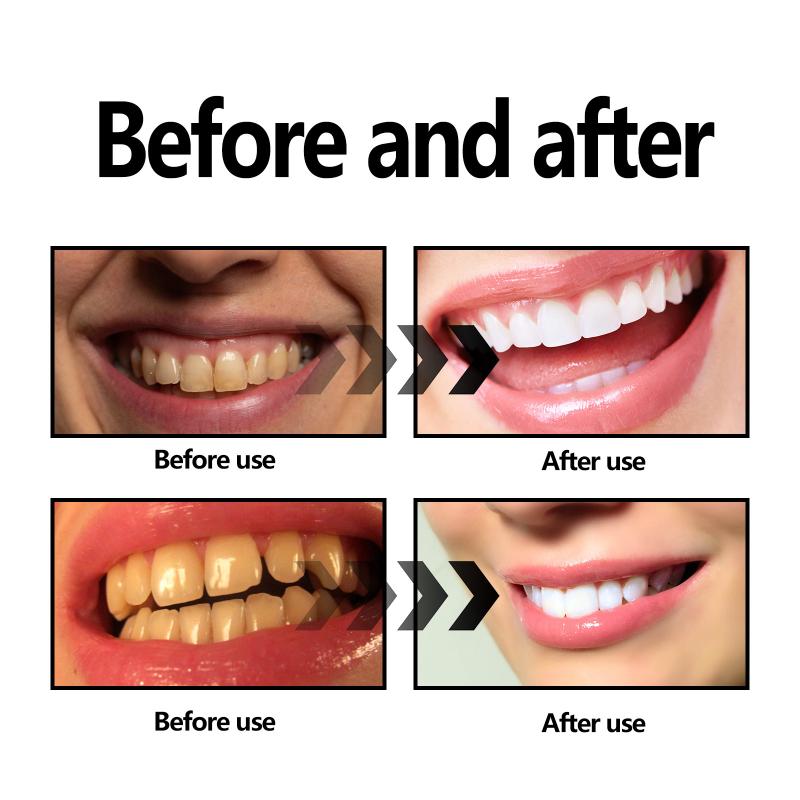 Zahnaufhellungspulver, Holzkoh – Teeth Whitening Baking Soda Bewertung und Preis