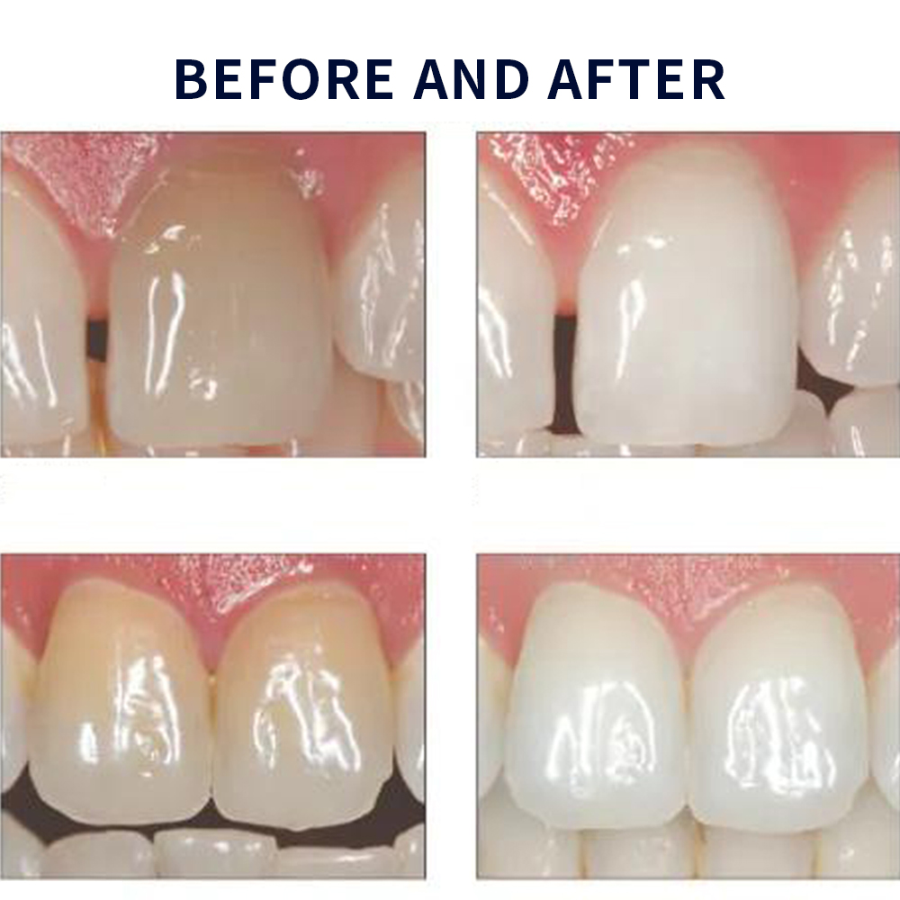 Opale scence White ning 1,2 pf – Teeth Whitening Home Kit Bewertung und Preis