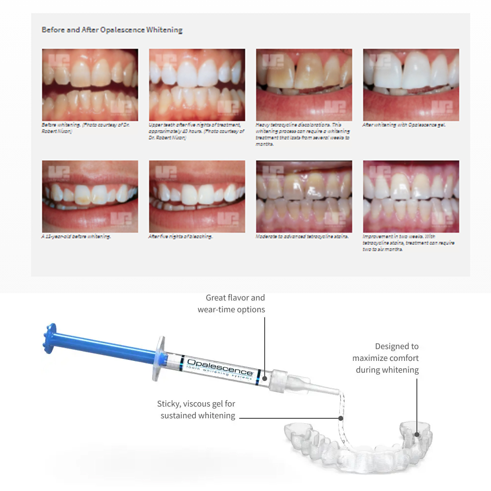 Opale scence White ning 1,2 pf – Teeth Whitening Home Kit Bewertung und Preis