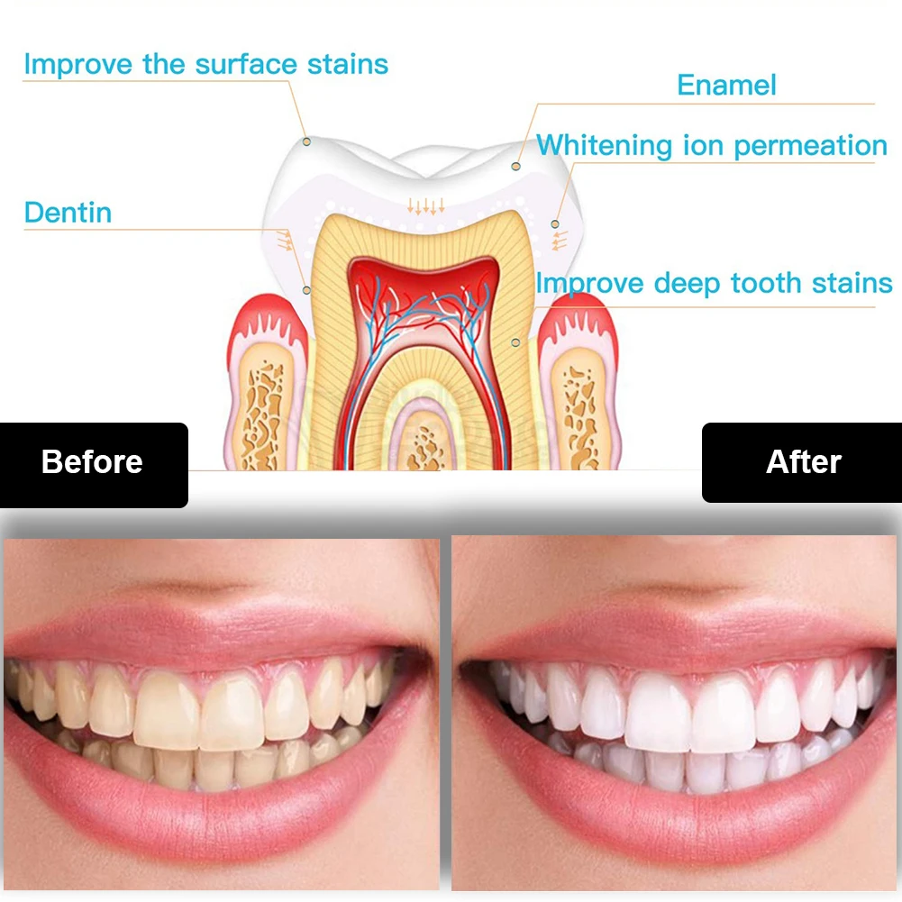 Dental Zahnaufhellung Kit Mini – Teeth Whitening Zoom Bewertung und Preis