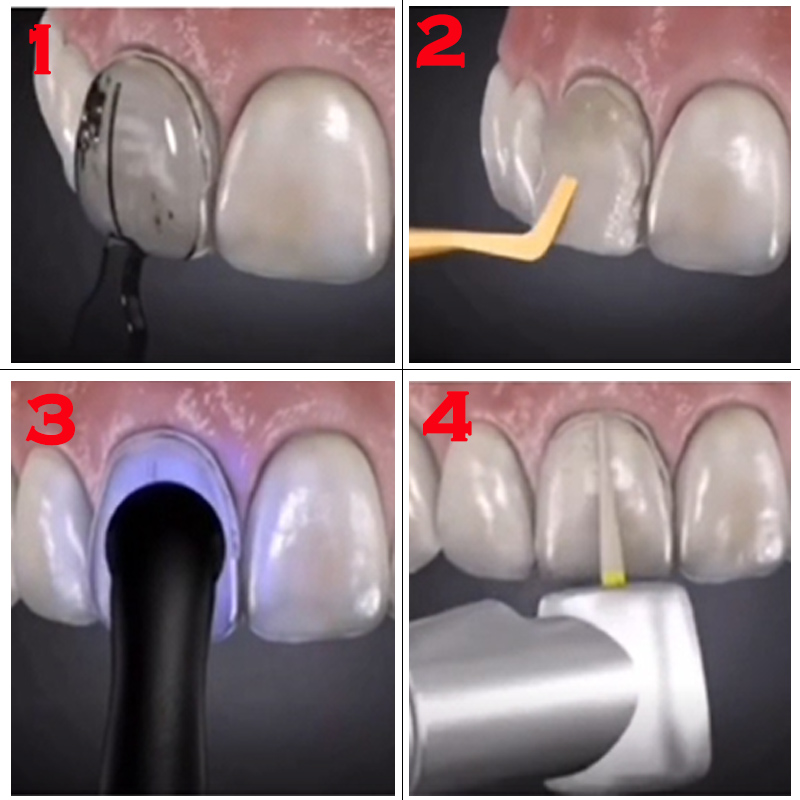 32-teiliges Dental-Veneer-Form – Teeth Whitening Kit With Light Bewertung und Preis